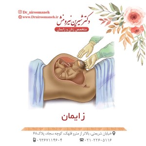 زایمان -دکتر نیرومنش