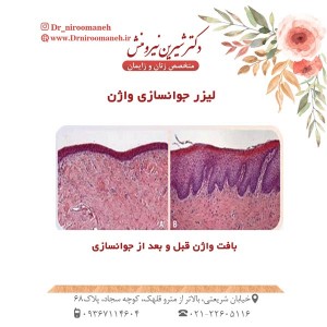 لیزر جوانسازی واژن _دکتر نیرومنش