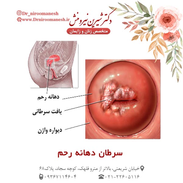 عکس سرطان دهانه رحم - دکتر شیرین نیرومنش