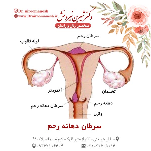 عکس سرطان دهانه رحم - دکتر شیرین نیرومنش