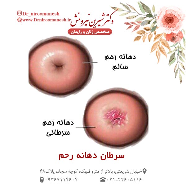 سرطان دهانه رحم