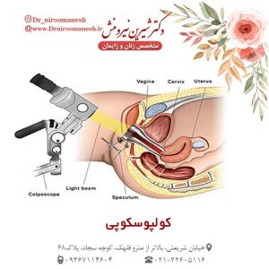 کولپوسکوپی