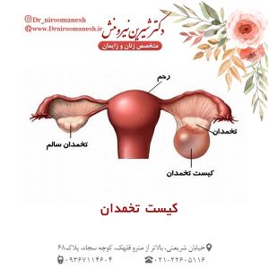کیست تخمدان - دکتر شیرین نیرومنش