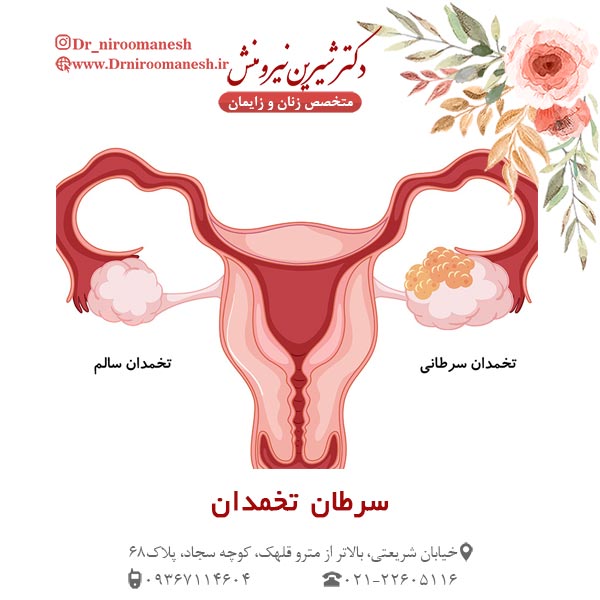 سرطان تخمدان