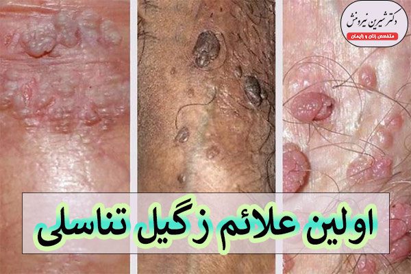 عکس زگیل تناسلی در مردان - دکتر شیرین نیرومنش