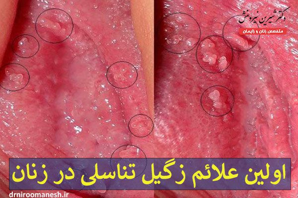 عکس زگیل تناسلی در زنان - دکتر شیرین نیرومنش