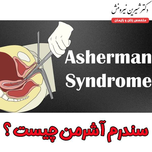 سندرم آشرمن چیست ؟ - دکتر شیرین نیرومنش