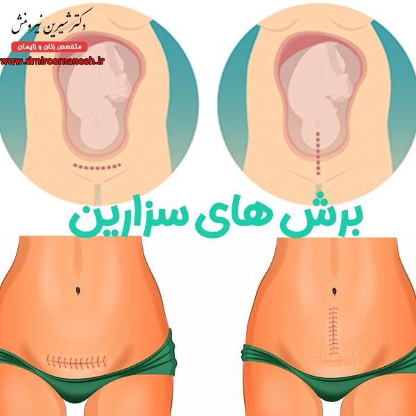 برش های سزارین
