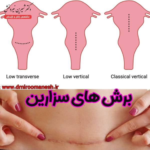 عکس برش های سزارین