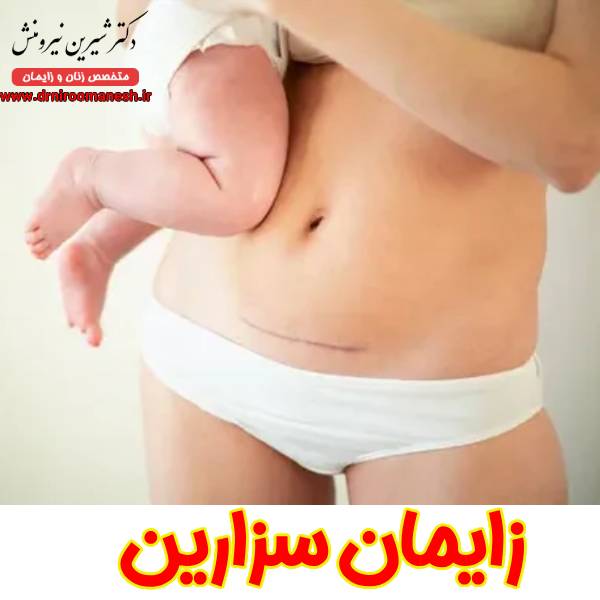 زایمان سزارین