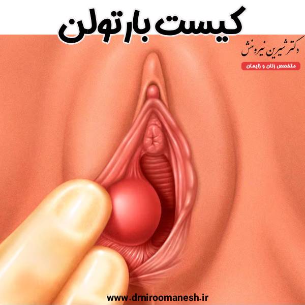 کیست بارتولن - دکتر شیرین نیرومنش