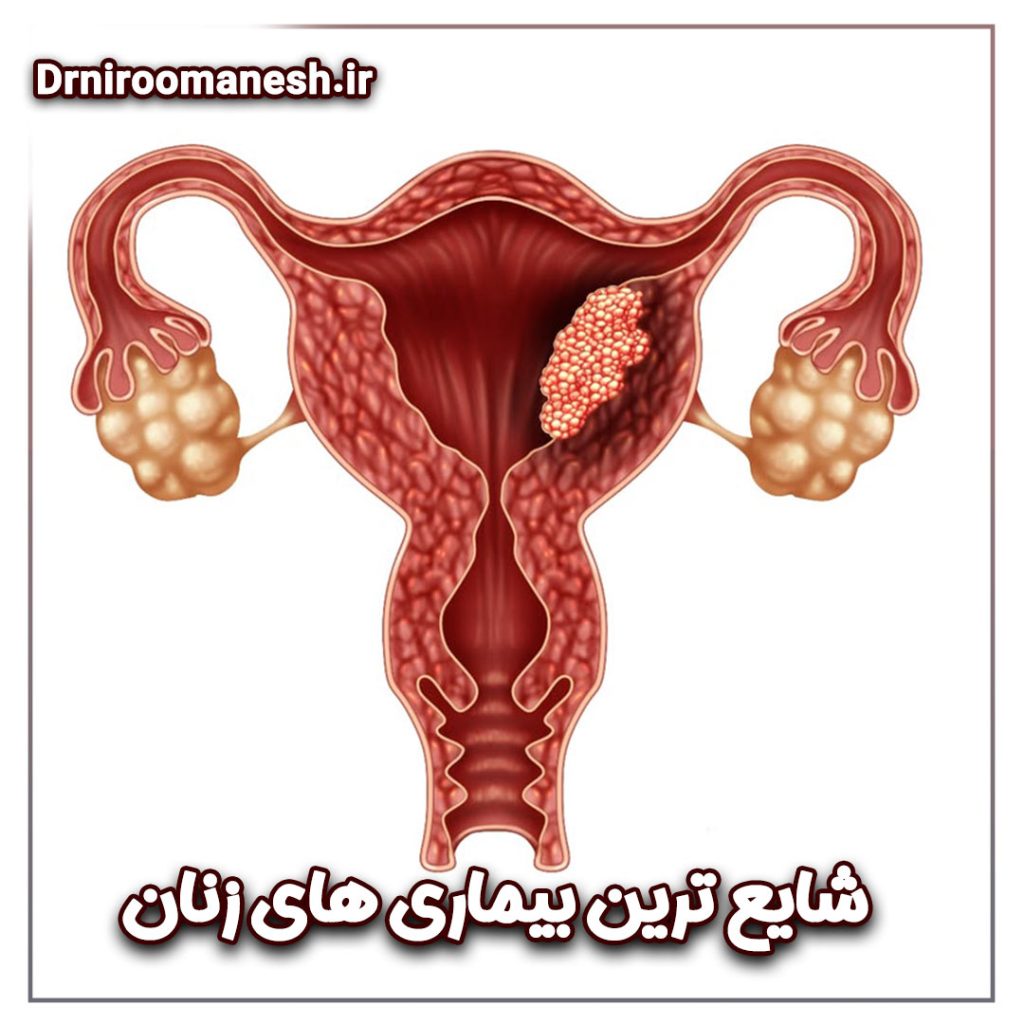 شایع ترین بیماری های زنان