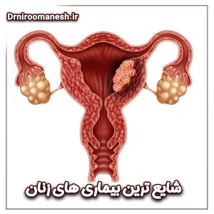 شایع ترین بیماری های زنان